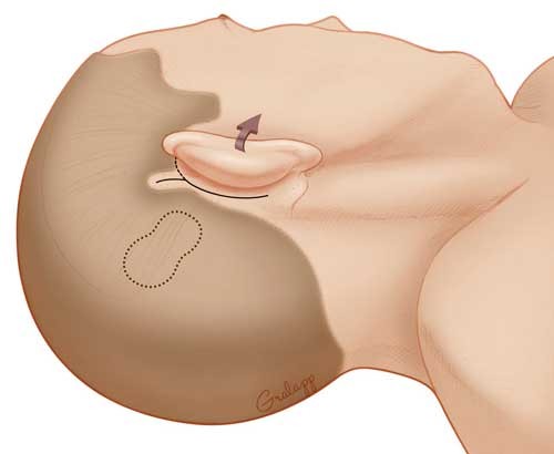 Cochlear-implant-incision