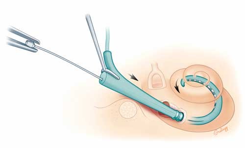 Cochlear-implant-placement