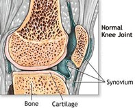 rheumatoid_arthritis