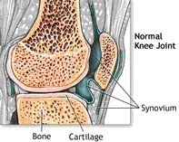 rheumatoid_arthritis