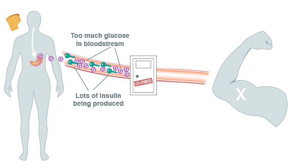 Insulin resistance - too much glucose in bloodstream